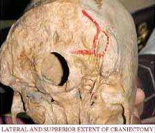 LAT_SUP_EXT_OF_CRANIECTOMY_copy